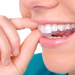 s-clearAligners